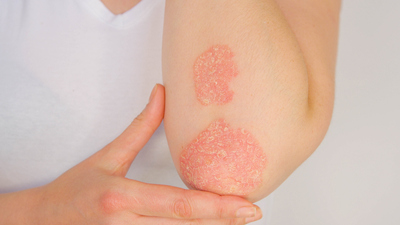 Tips to treat Psoriasis 