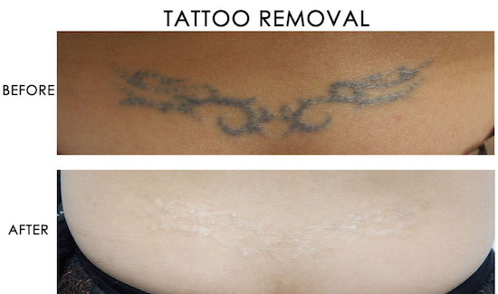 get rid of an unwanted tattoo laser tattoo removal has