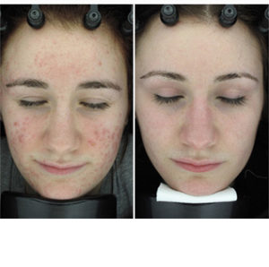 Fractional CO2 Laser Resurfacing before & after