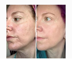 Fractional CO2 Laser Resurfacing before & after