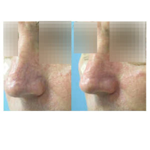 Laser Vein Removal before & after