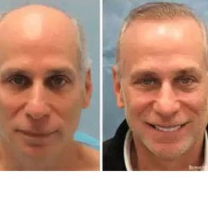 Hair Restoration before & after