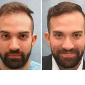 Hair Restoration before & after