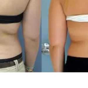 ZELTIQ Non-Surgical Fat Reduction before & after