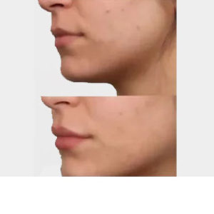 Filler before & after