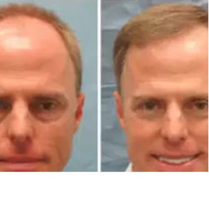 Hair Restoration before & after