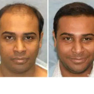 Hair Restoration before & after