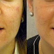 before and after images of best acne treatments - patient 4