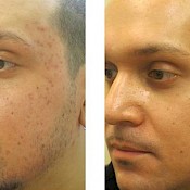 before and after images of best acne treatments - patient 9