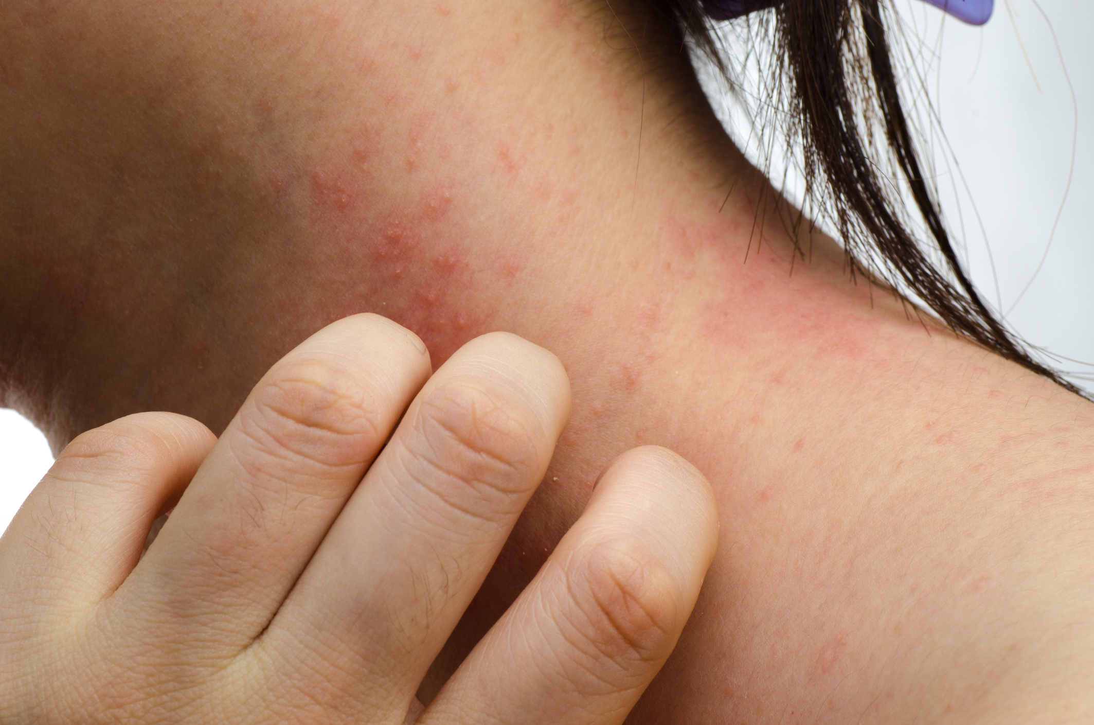 contact dermatitis