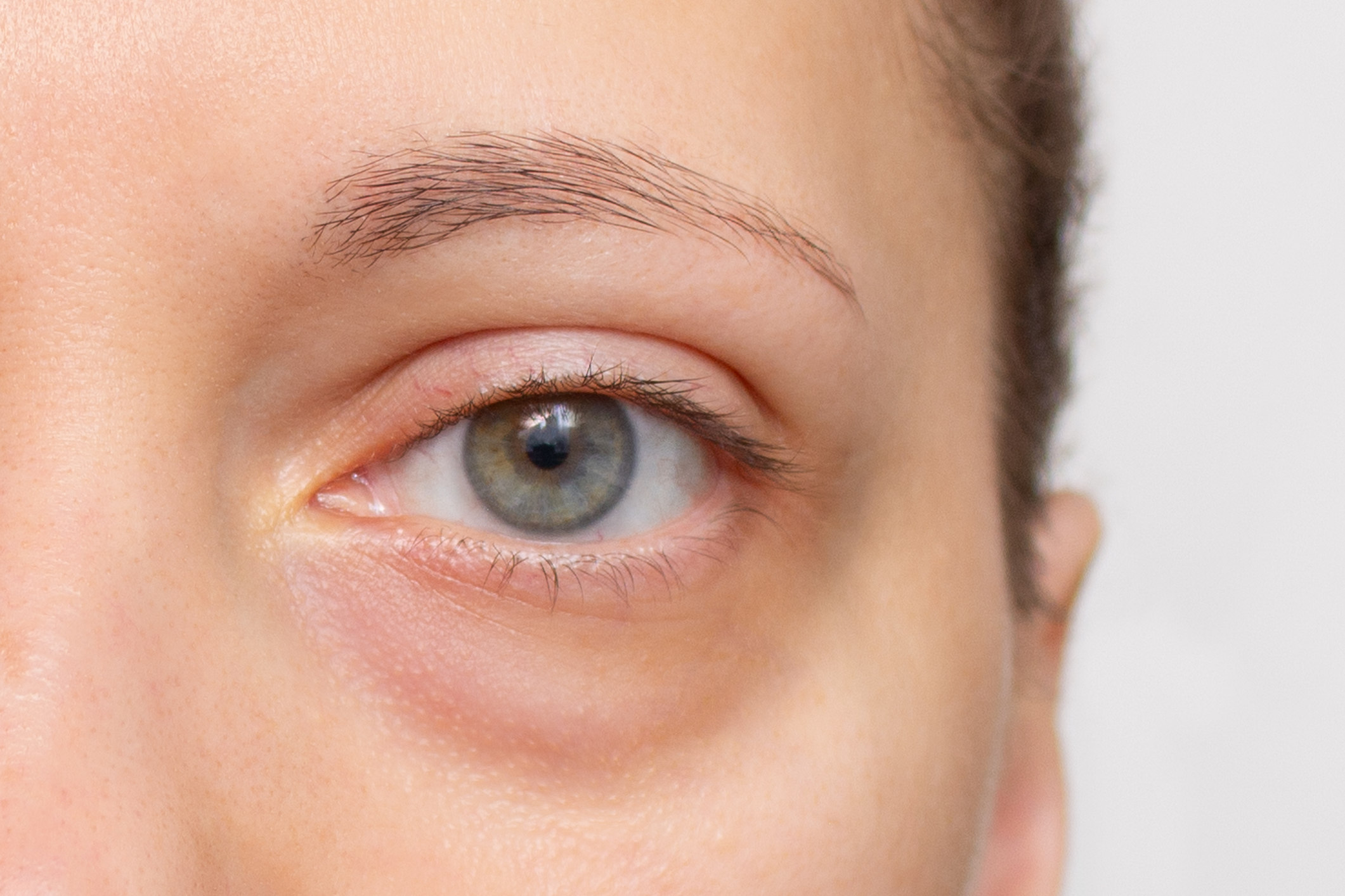 closeup of dark circles due to allergies