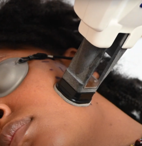 Non-invasive laser treatment of acne scarring