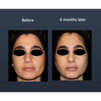 Before and after images of a female patient who successfully underwent exosome treatment.