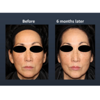 Before and after images of a female patient who successfully underwent exosome treatment.