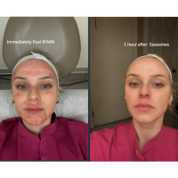 Before and after images of a female patient who successfully underwent exosome treatment.