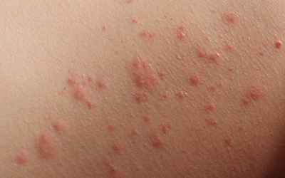 Contact Dermatitis Treatment | Treating Contact Dermatitis